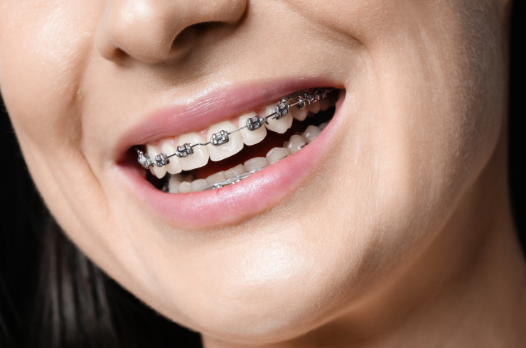 Orthodontic Treatment